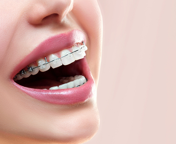 Invisalign: The clear way to straighten a smile - Dentist on Dundas